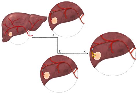transarterial chemoembolization  hepatocellular carcinoma