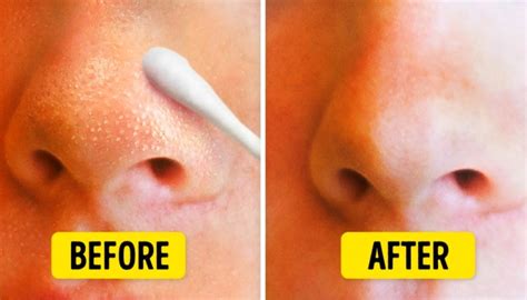 Extreme blackhead removal before and after: get rid of blackheads