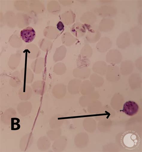 Plasmodium vivax amoeboid and schizont forms in PBS 3