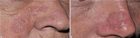 granuloma faciale clinical   patient   patient