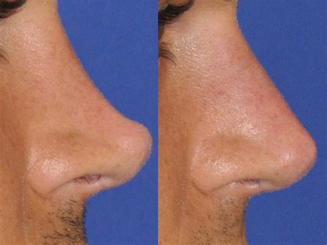 surgical rhinoplasty    mehta plastic surgery