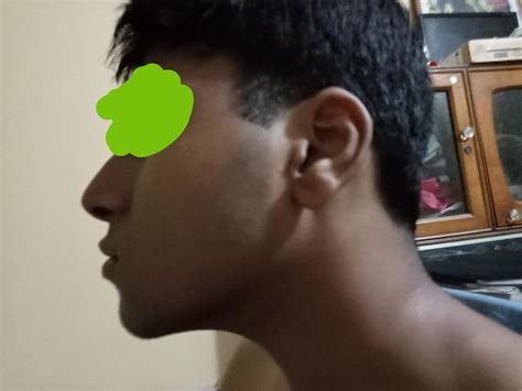 How can I decrease the puffiness in my face? : r/Mewing