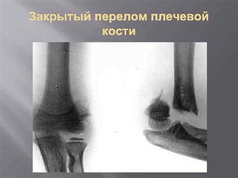 ПЕРЕЛОМЫ Переломы Переломы что это такое