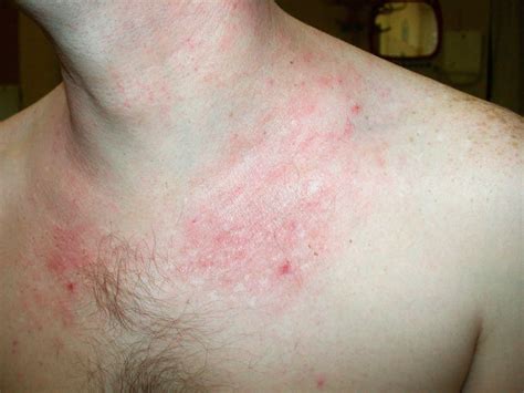 Dermatitis - Pictures