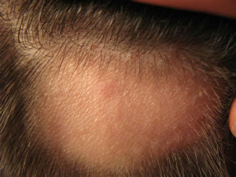 Explainer: what causes alopecia areata and can you treat this type of ...