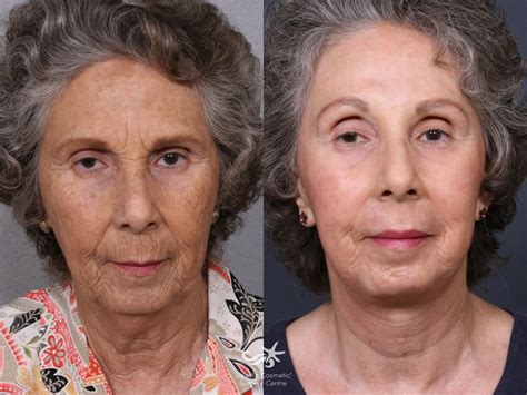 Let’s Deep Dive Into Deep Plane Facelift Recovery Day By Day | La Jolla ...
