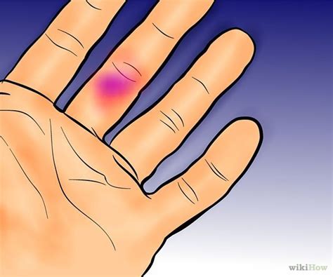 17 Best images about Broken Finger on Pinterest | Broken toe, X rays ...