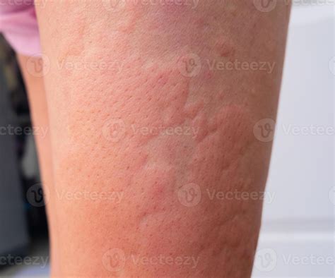 allergy rash of dermatitis problem. skin problem from drug allergy ...
