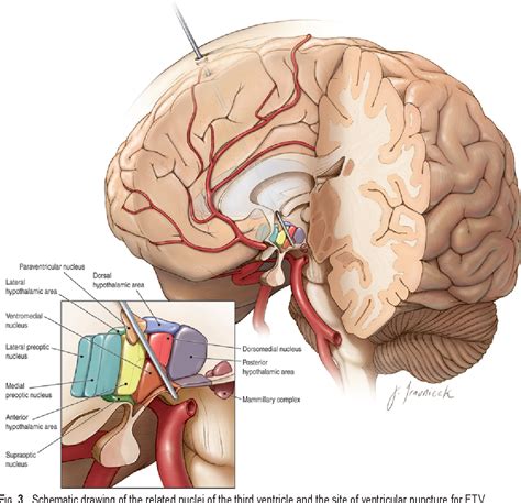 Third Ventricle Anatomy - Anatomical Charts & Posters