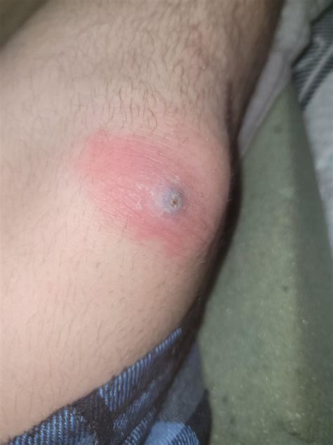 I've had this bump developing on my knee for over a week now. It's