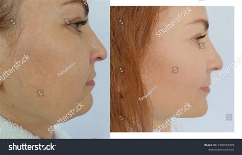 Woman Face Wrinkle Before After Treatment Stock Photo 2190591399 | Shutterstock