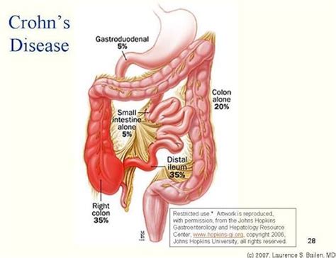 crohns disease gastroenterology  greater orlando