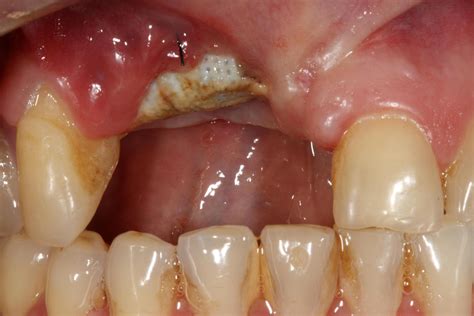 Dental Bone Graft Failure Signs at Ruby Hereford blog