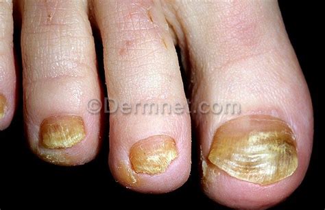 Yellow Nails Photo - Skin Disease Pictures | Skin disease pictures ...