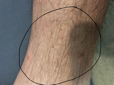 bed bug bites? exzema? something else? itches when stressed out. lower
