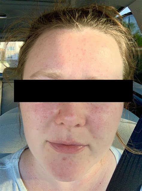 rosacea face cream 5