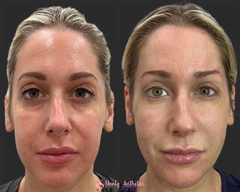 PDO Thread Lifting - Before and After Results at Skinly Aesthetics