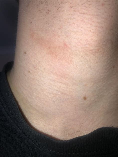 Got this bruise running across my adams apple no idea how it happened