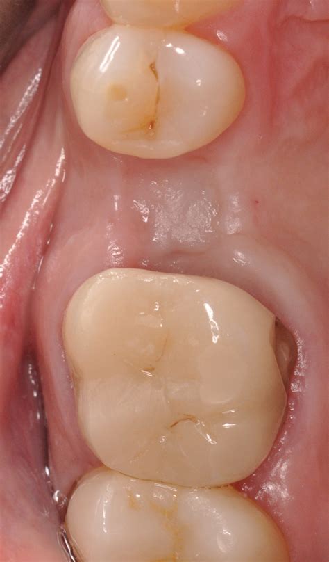The devil is in the details: case selection for optimal implant