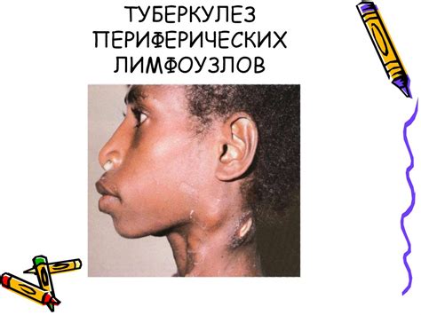 Туберкулез - презентация онлайн
