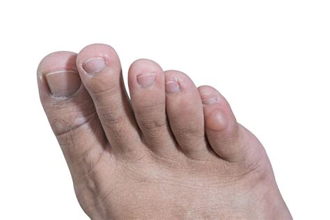 Treatment For Blister On Foot Online | emergencydentistry.com