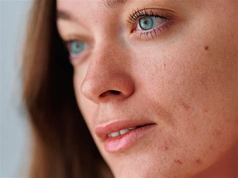 Taming the Duo: Dry Skin with Breakouts – esmi Skin Minerals