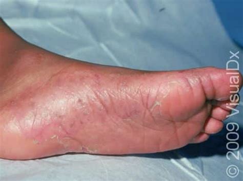 Dyshidrotic Eczema Feet