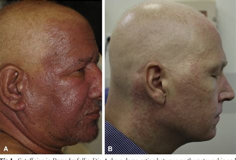 Figure 1 from Sparing of the scalp in severe Demodex folliculitis after ...