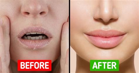 refresh  dry lips  easy remedies  chapped dry lips curious mob