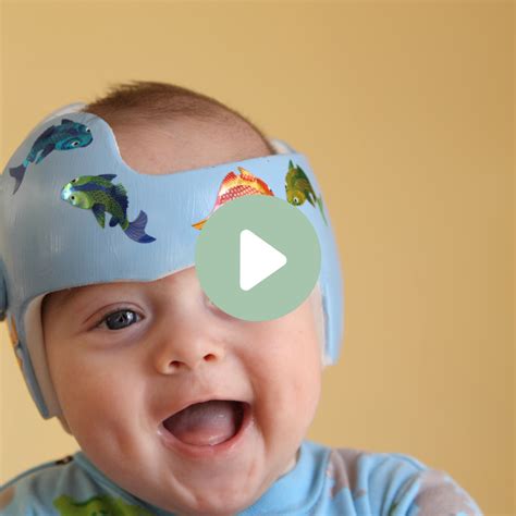 plagiocephaly flat head parentmd