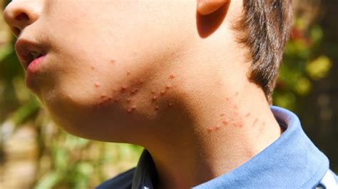 How To Identify 8 Common Bug Bites