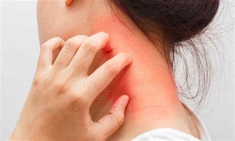 На століттях червоні плями лушкуються: причини, лікування, профілактика