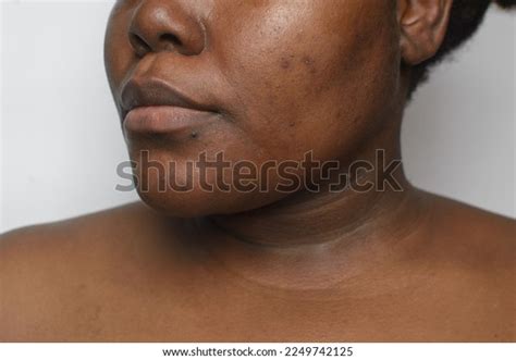 brown skin dark spots hyperpigmentation  stock photo
