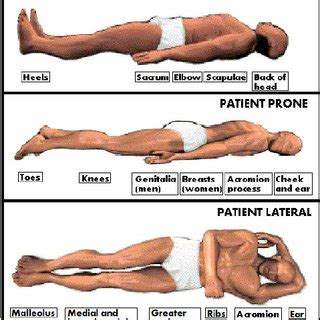 norton scale  pressure ulcer risk assessment  scale  created