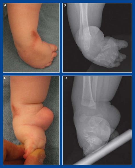 Types Of Foot Deformities at Carl Buteau blog