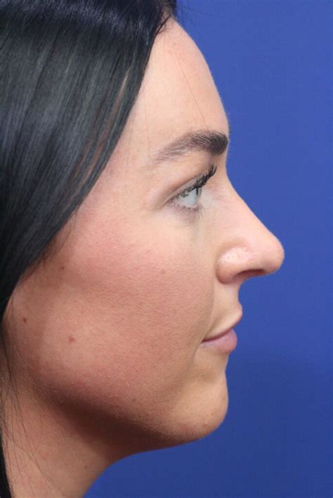 Rhinoplasty | Nose Surgery Near Me