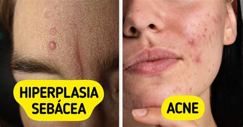 Bolinhas Que Parecem Espinhas - 7 Bolinhas na pele que enganam e parecem espinhas comuns