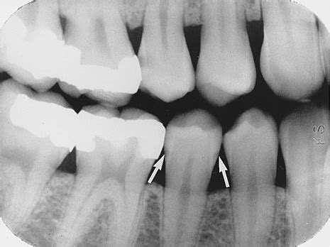 Caries and restorations Flashcards | Quizlet