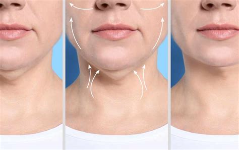 5 Cara Melancipkan Dagu dengan Non-Operasi - Privee Clinic