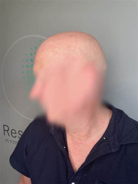Alopecia Totalis (AT)