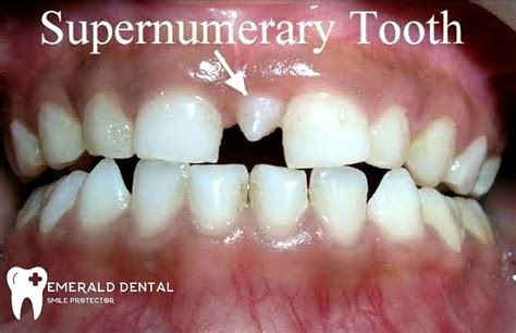 SUPERNUMERARY TOOTH - EMERALD DENTAL