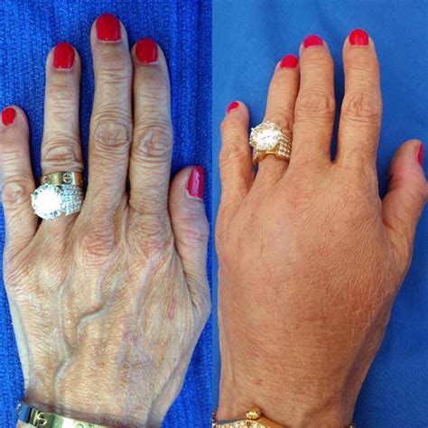 List 93+ Pictures Plastic Surgery For Hands Before And After Photos ...