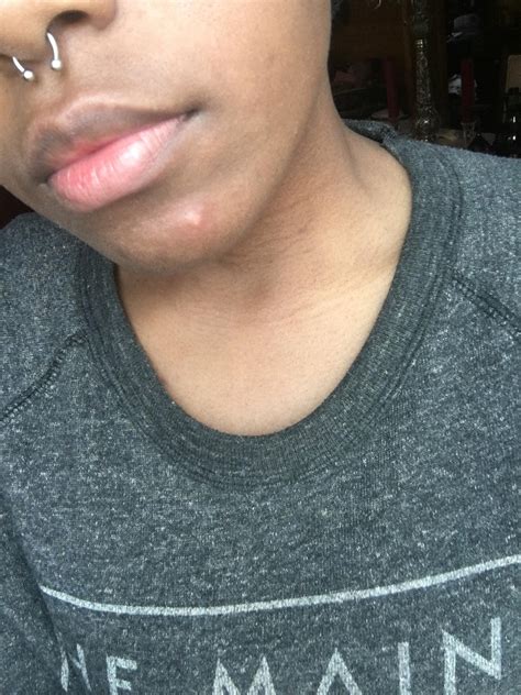 The once cystic zit that I get lives on my chin and comes back every