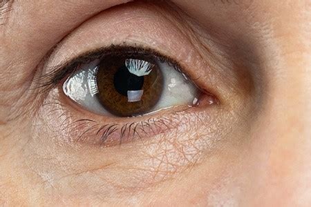 dark eye circle treatment eye bags treatment pj