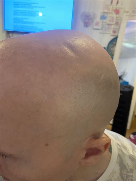 Sudden indentation in my skull ..please help 🤔 : r/multiplemyeloma
