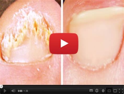 Rub This Yellow Powder On Your Toes To Get Rid Of Fungus - Jack ...