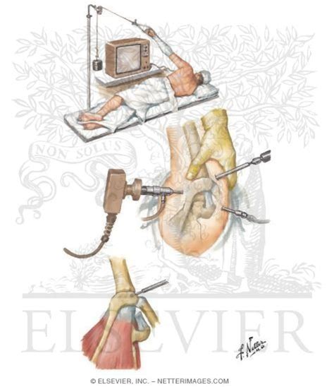 Arthroscopic Acromioplasty