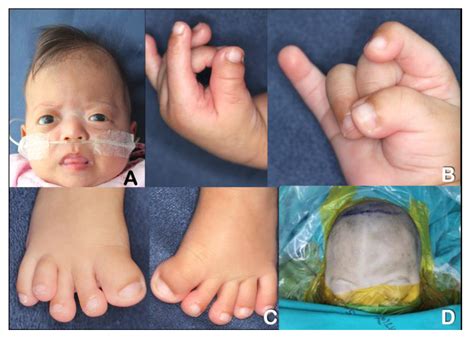 type 2 pfeiffer syndrome