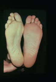 Diabetic Foot Examination Flashcards | Quizlet