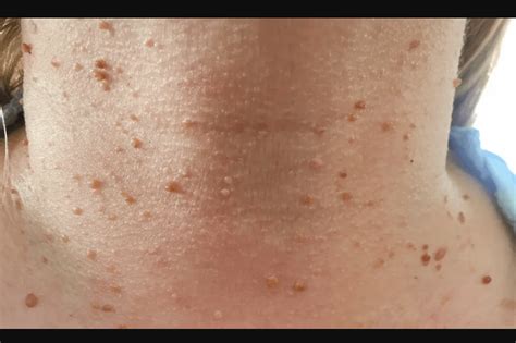 What Causes Skin Tags on Neck: Understanding the Common Triggers